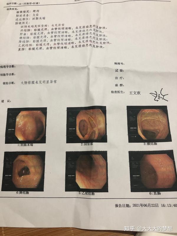 疑似克罗恩病的缓解scd食疗