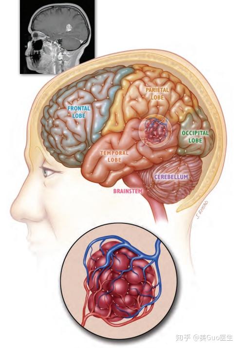 "脑动脉瘤","脑海绵状血管瘤"傻傻分不清楚