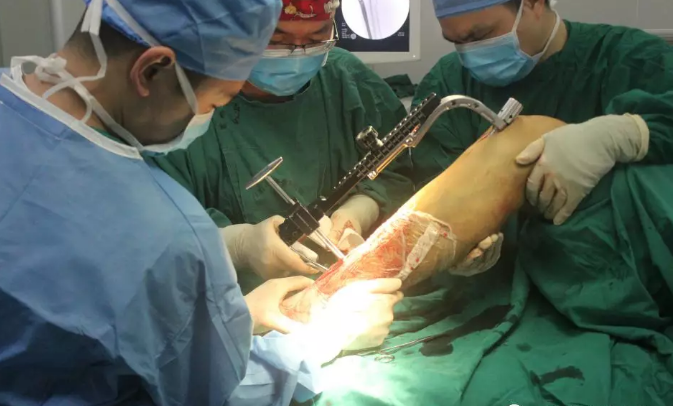 小腿骨折的微创手术髓内钉固定术
