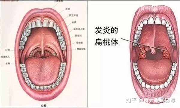 首大陈潜:保留,还是切除?--扁桃体肥大患者的困惑