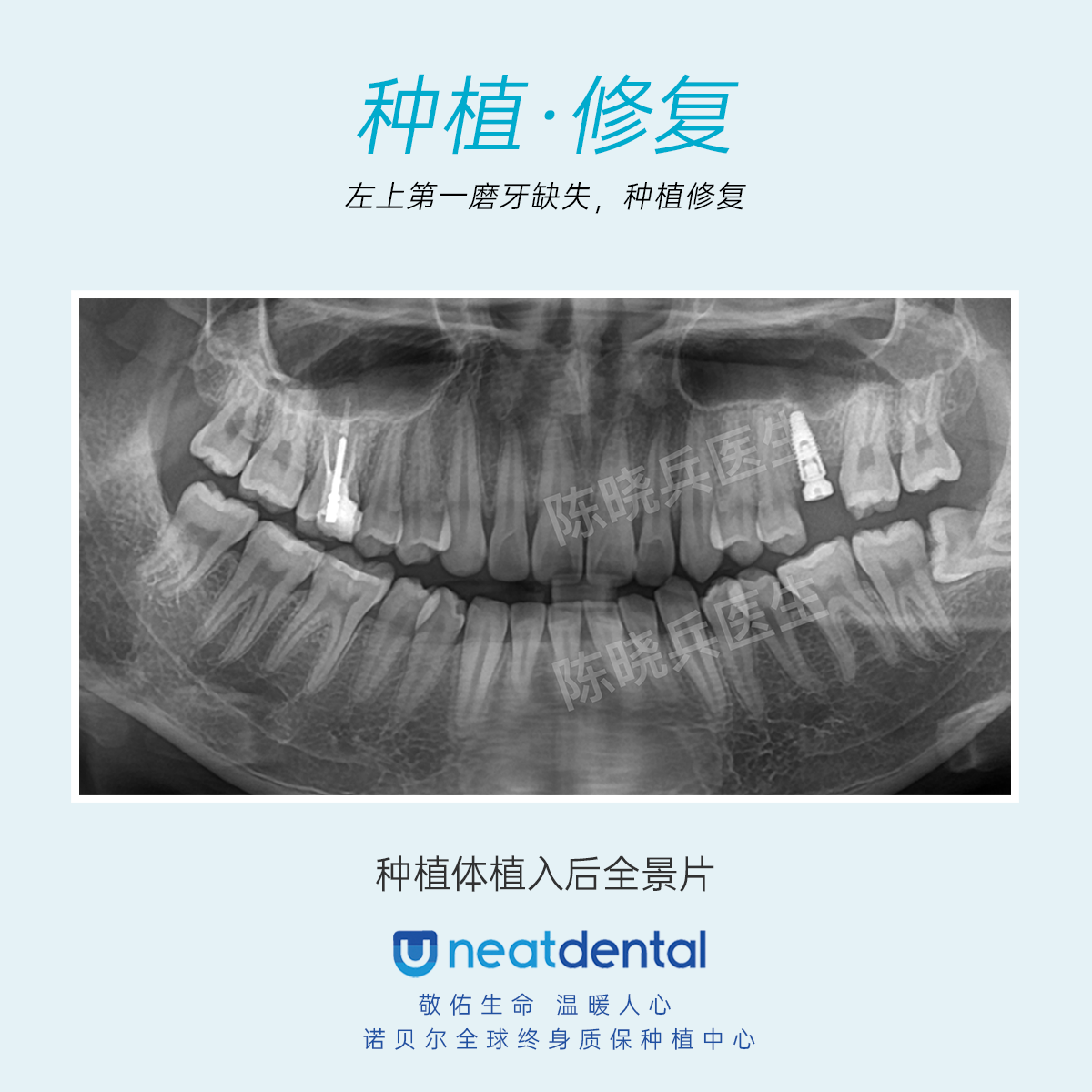 广州种植牙:种牙完整流程分享