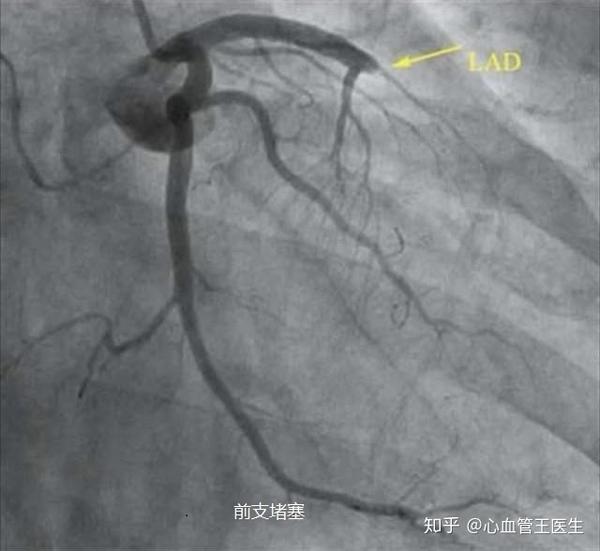 心脏血管堵了一根还有两根能正常运转吗?听听心脏介入