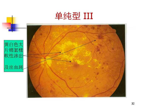 糖尿病视网膜病变科普系列二眼底表现情况