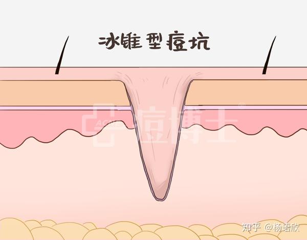 科普解析|痤疮的分型分类(你的痘痘到底是哪种)