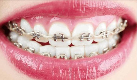 传统金属牙套需要结扎丝来固定钢丝线,而金属自锁牙套支架采用滑动