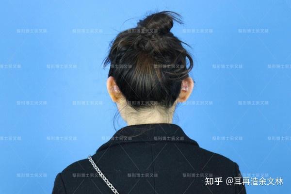 【案例故事】双耳贴脑富贵到老?她却因贴发耳太影响美观做了矫正手术
