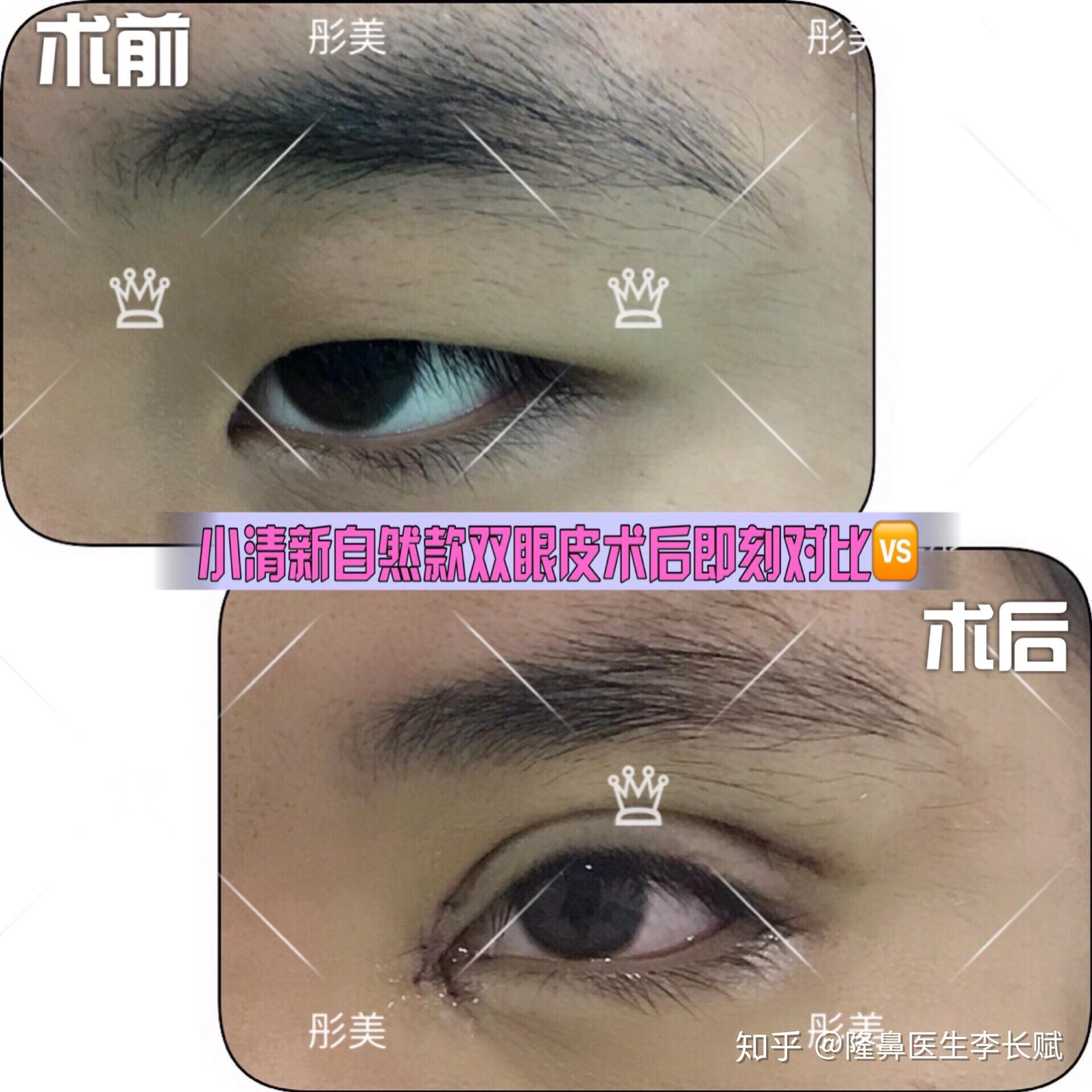 这种也属于单纯性单眼皮,这个就是单项做一个双眼皮术后即刻的照片