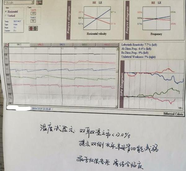 温度试验:显示双侧外半规管超低频功能下降