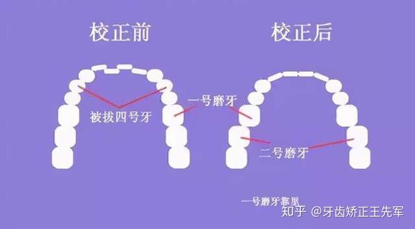 苏州牙齿矫正-如何判断咬合是否正常?