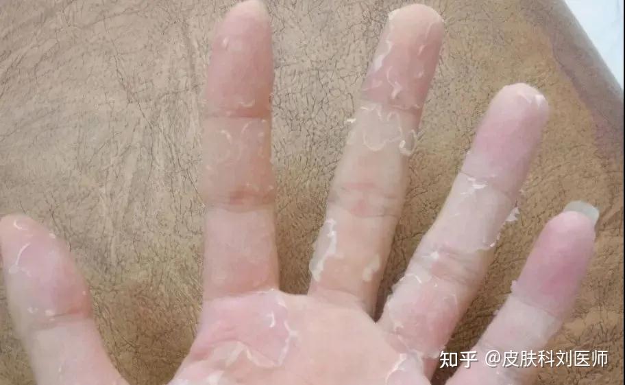 【郑州皮肤科】手部脱皮的4大原因,竟然是这个病!