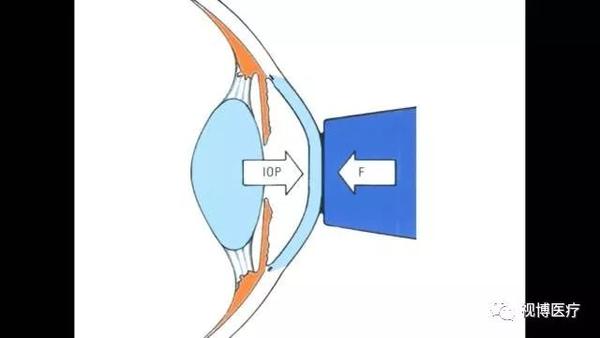 科普:goldman 压平眼压计测量眼压使用方法