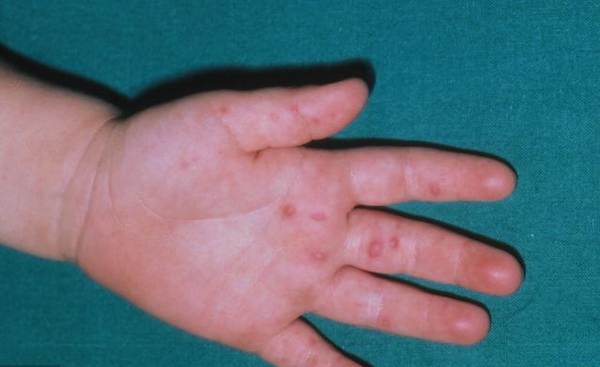 传染病高发季节又来了,手足口病初期症状你分清了吗?