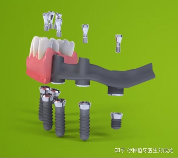 郑州瑞士iti种植牙:种植导板下无牙颌种植修复,恢复全
