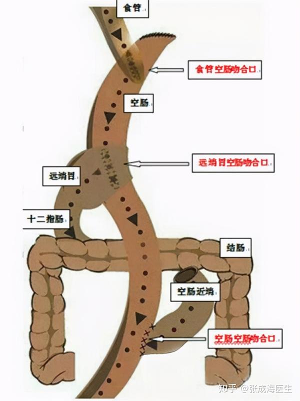 另一条通道直接经过与食管吻合的空肠进入下段小肠