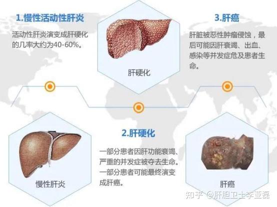 【科普】肝硬化失代偿期,情况有多严重?