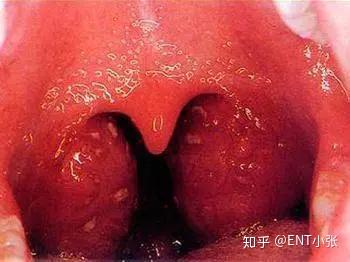 科普切除扁桃体和腺样体对免疫力会造成影响吗