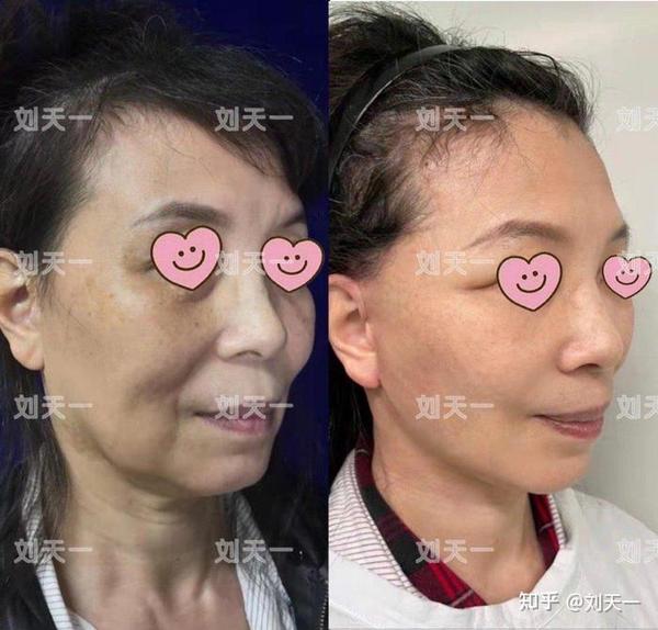 拉皮手术第一次不满意可以做修复吗?(5)术后十天效果如何?
