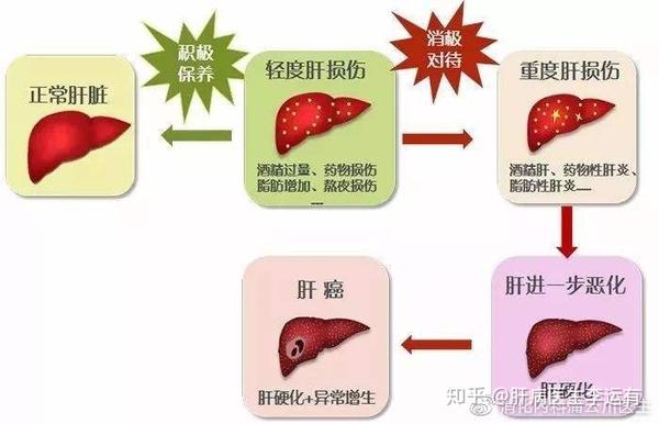 急性肝炎与慢性肝炎的区别:慢性肝炎更容易变成肝硬化