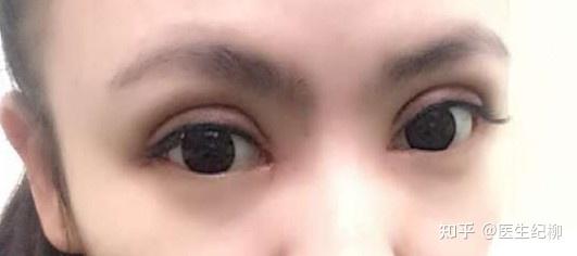 由上面看出,明星们并不是单单去割双眼皮,而是去按照审美标准做眼部