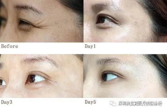 好莱坞女星人人点赞的除皱大法你也可以的