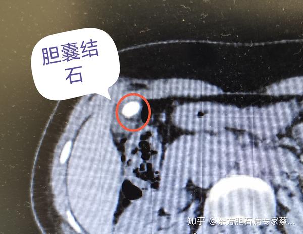 胆囊腺肌症合并胆囊结石和胆囊息肉,可以微创保胆手术