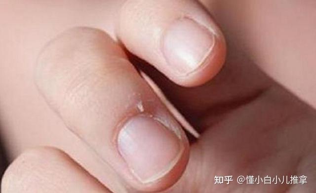 指甲盖一按就疼 zhuanlan.zhihu.com