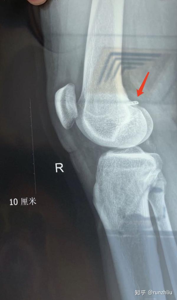 前天复查的x光片,可以看到韧带固定的铆钉的位置