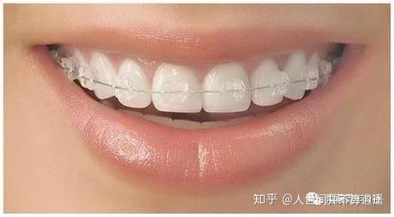 陶瓷自锁牙套_陶瓷自锁牙套牌子_美国3m陶瓷自锁牙套