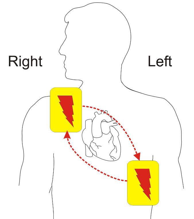 【急救技术-心外除颤术】除颤术英文简称"d",即defibrillation