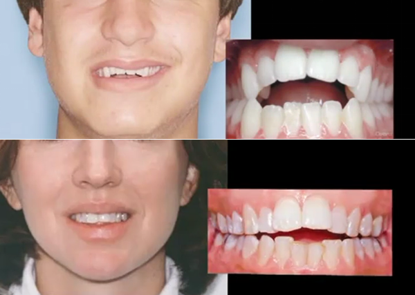 牙齿开颌可以通过正畸改善吗