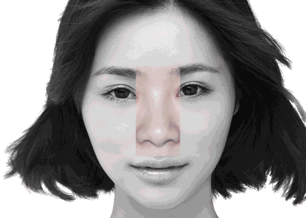 隆鼻手术是在鼻腔外进行,对鼻腔内部的鼻甲及组织结构没有任何的影响
