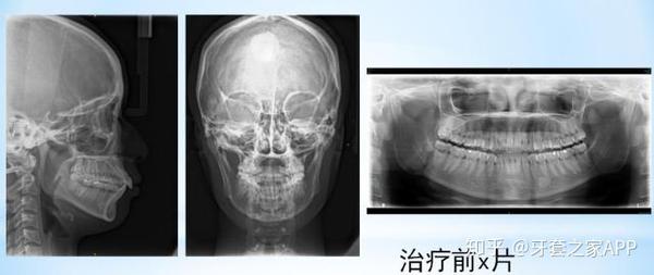 微创正颌一种小创伤的正颌手术