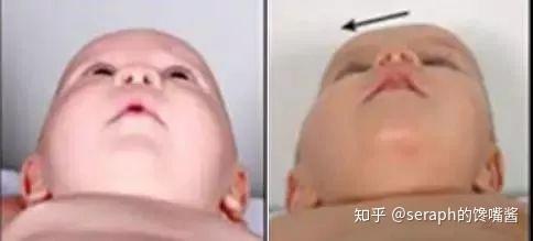 发现自己左右脸不对称—怎么改善左右脸不对称的问题?