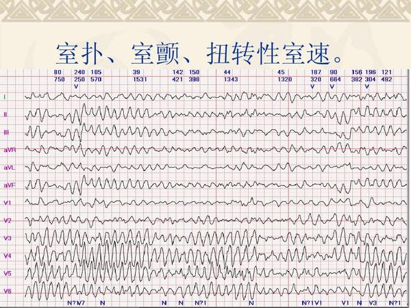 还有一种心肌梗死通过心电图不能迅速诊断,心电图只能发现st段压低,这