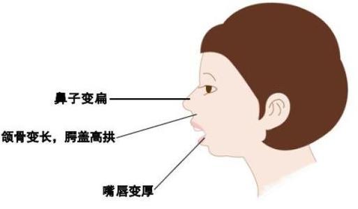 小宝宝经常用嘴呼吸,产生的四种危害,很多人都不知道!
