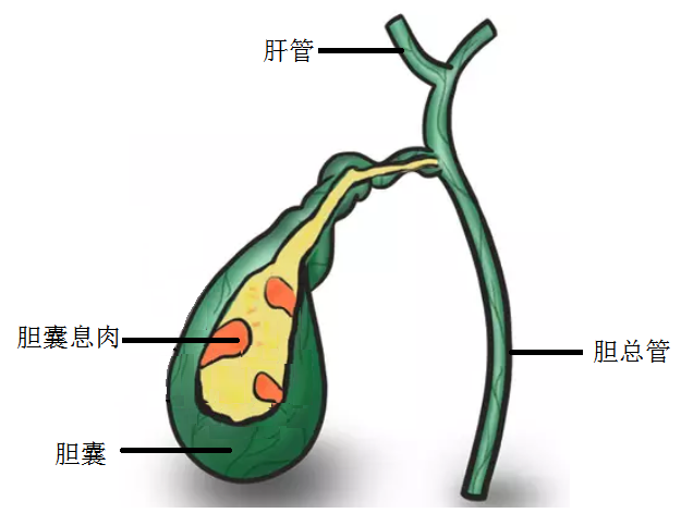 胆囊息肉,你离胆囊癌有多远—黄安华胆病科普系列