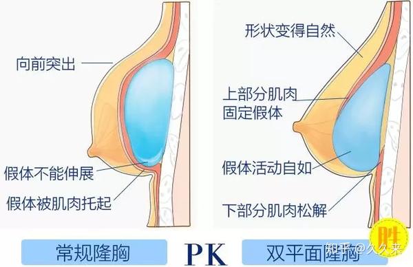 隆胸会对以后哺乳产生不好