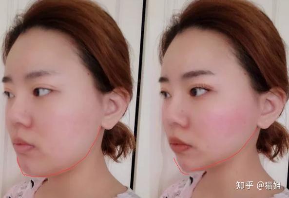 面部吸脂价格贵不贵?风险有多大?
