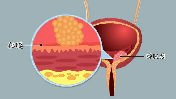 外科医院院长 膀胱肿瘤,是泌尿系常见肿瘤,也是膀胱壁的非正常生长