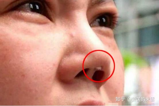 假体硅胶隆鼻用不用耳软骨垫鼻尖有什么区别?有垫的必要性吗?