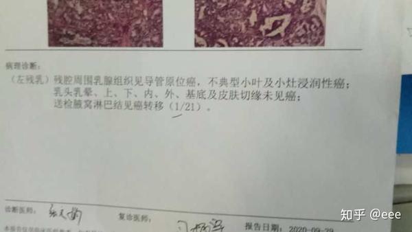 各位母亲得了乳腺癌病理报告如下麻烦有没有了解这些的医生或者朋友