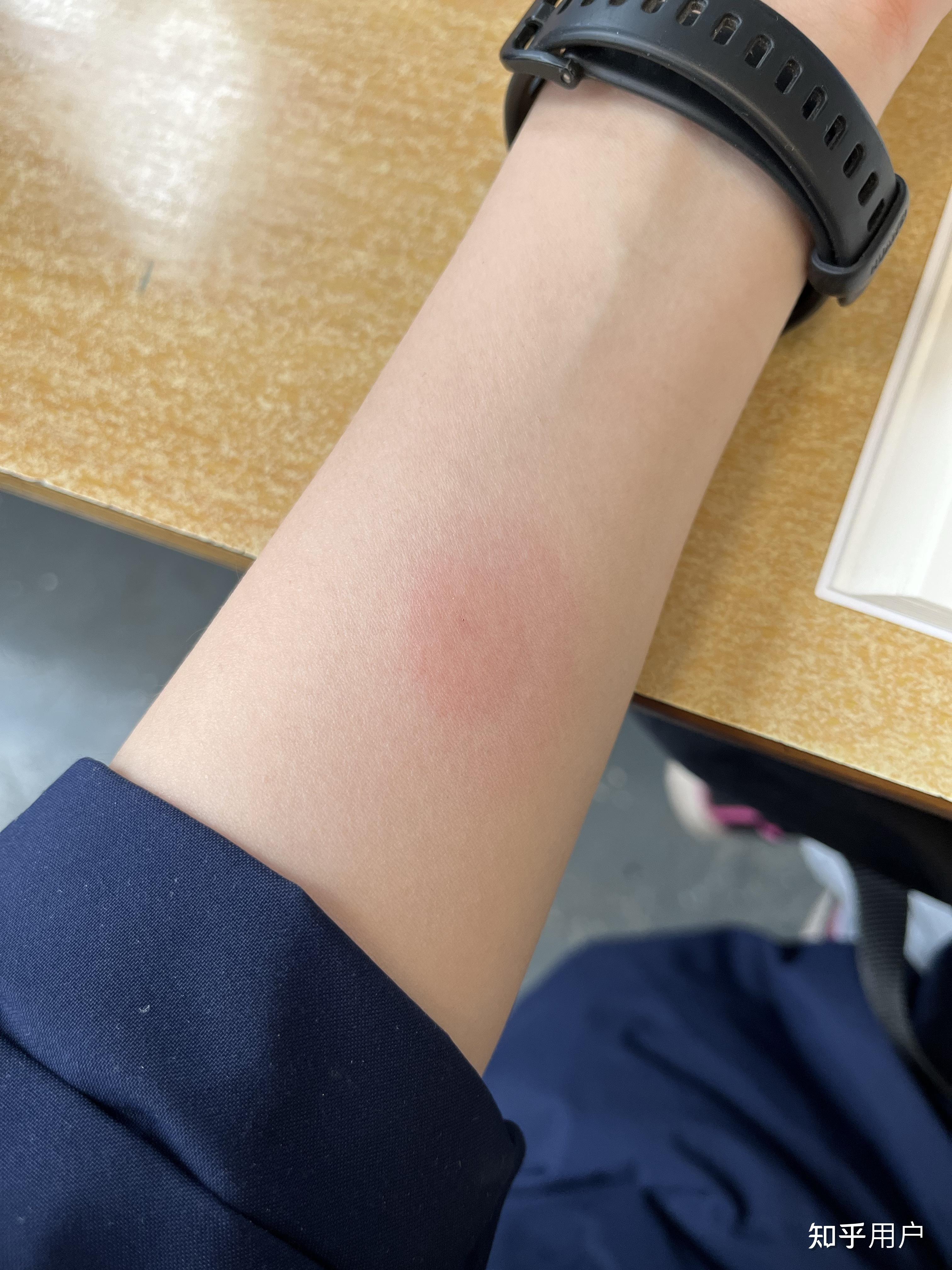 ppd皮试后这个样子怎么办