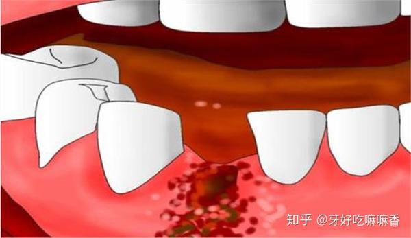 拔牙后不能吐口水一定要往肚子里咽