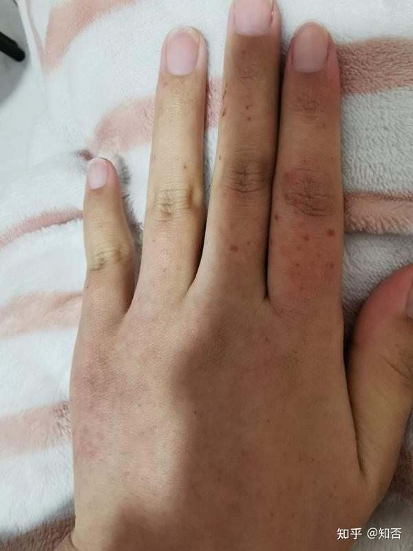 手上起了很多红点点,左手今天一看手背上面起来很多,还不是很明显,一