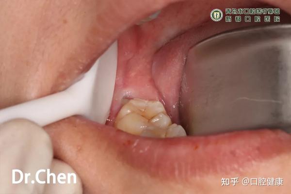 患者主诉 患者,女性,因右下智齿周围牙龈反复发炎,要求拔除右下智齿.