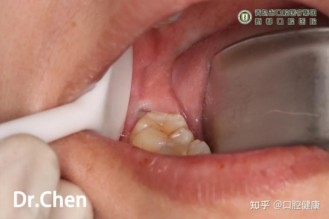 病例展示医用胶原蛋白减轻拔牙术后反应病例