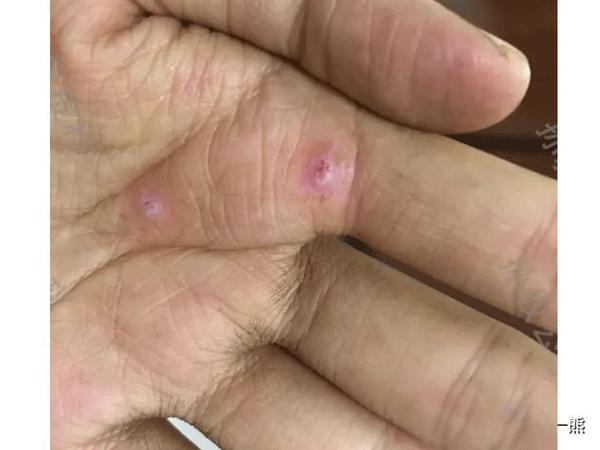 泡七味汤,修理发出来的疣体根部