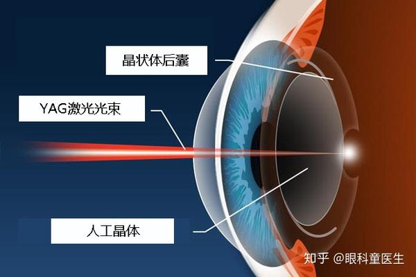 的视频来了解一下yag晶状体后囊切开术的模拟视频和一些相关的并发症