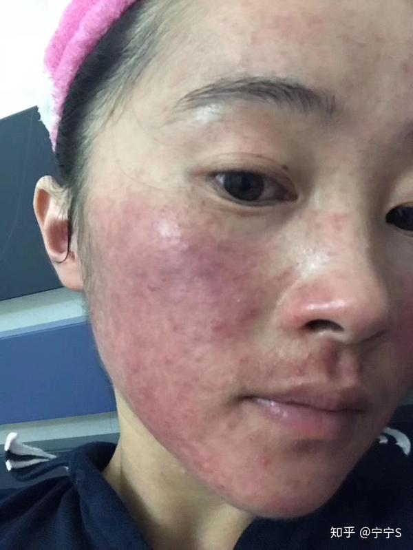 为什么脸部红肿痒痛干燥起皮过敏