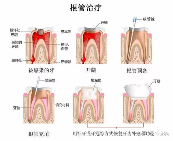 根管治疗的原理是什么?